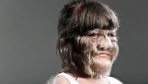 The Woman with Hypertrichosis